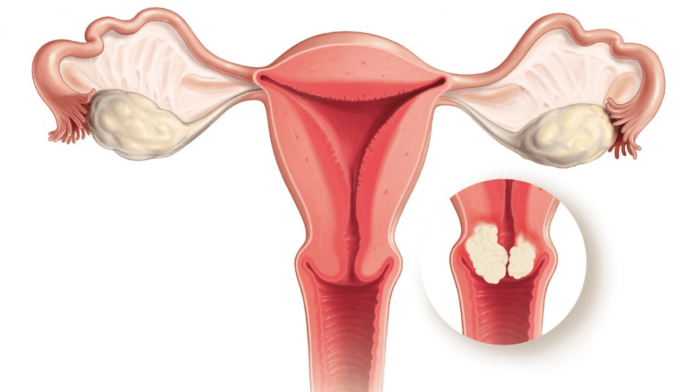 Cervical-cancer