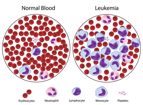 U.S.-Scientists-find-new-possible-cure-for-leukemia
