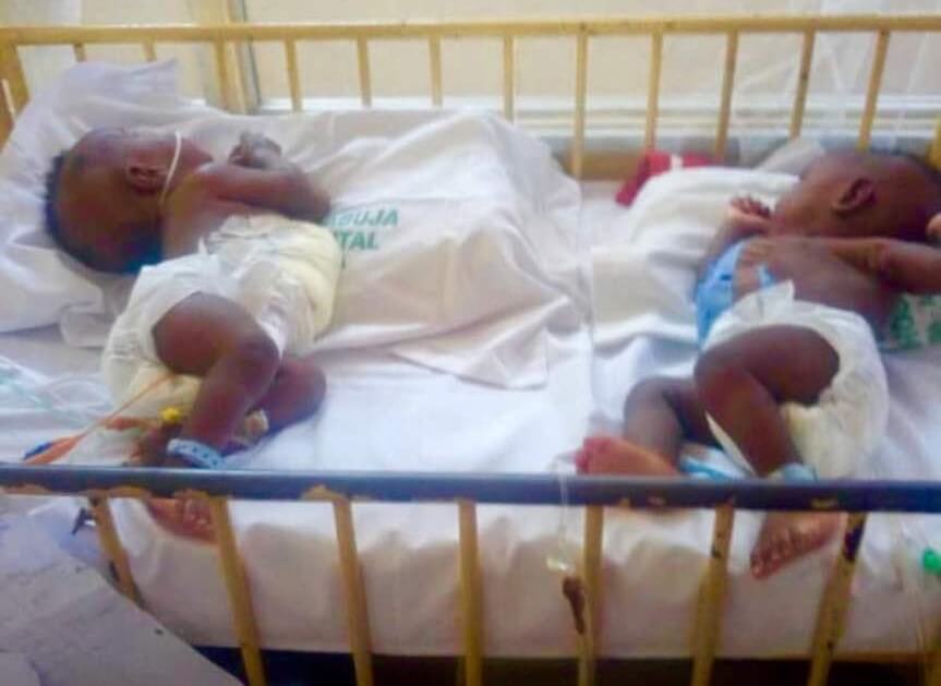 Doctors separate conjoined twins in Abuja hospital 2 (1)