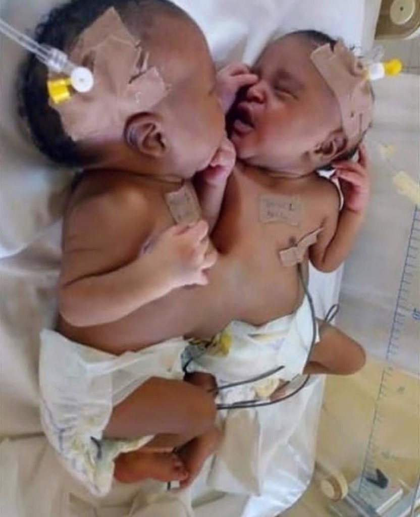 Doctors separate conjoined twins in Abuja hospital 2 (1)